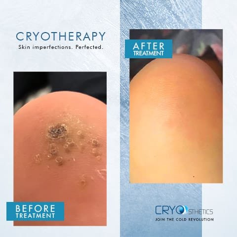 beforeandafter-cryotherapy5 Before and after cryotherapy