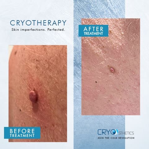 beforeandafter-cryotherapy7 Before and after cryotherapy